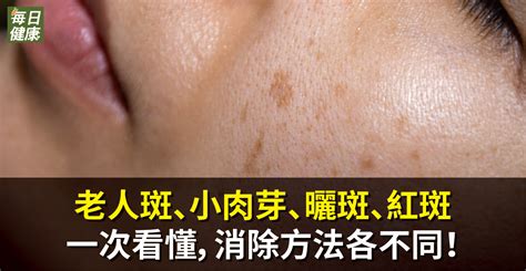 皮膚班|老人斑、小肉芽、曬斑、紅斑．一張圖看懂，消除方法。